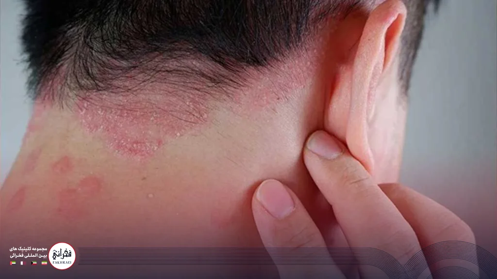 مردی دچار بیماری پسوریازیس سر