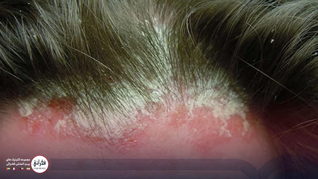 خانمی دچار بیماری پسوریازیس پوست سر
