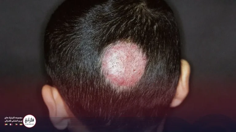 علائم کچلی قارچ سر