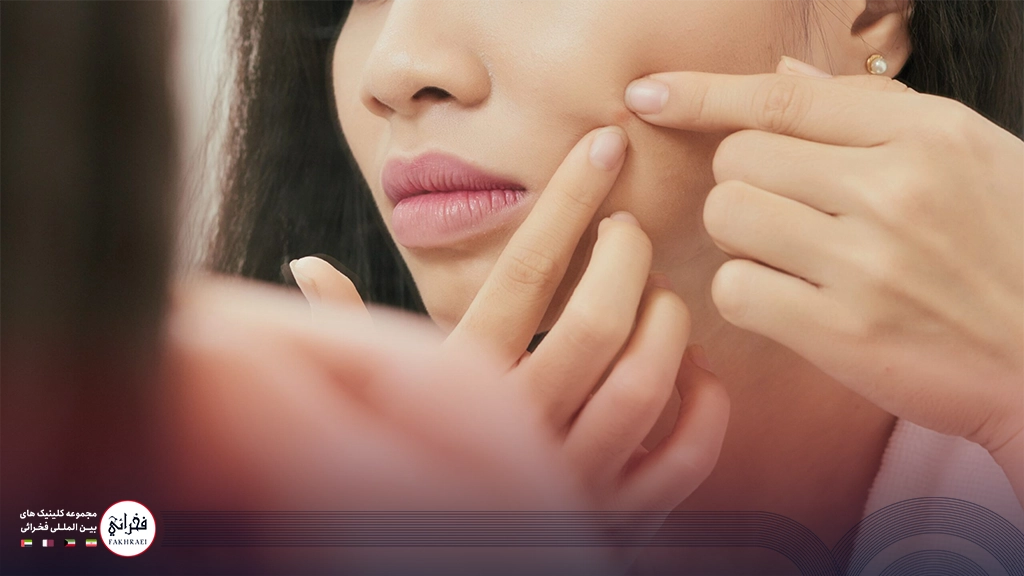 دختری در حال درآوردن جوش‌های زیر پوستی صورت 