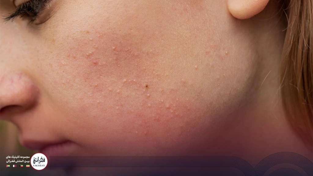 دختری با جوش‌های زیر پوستی صورت