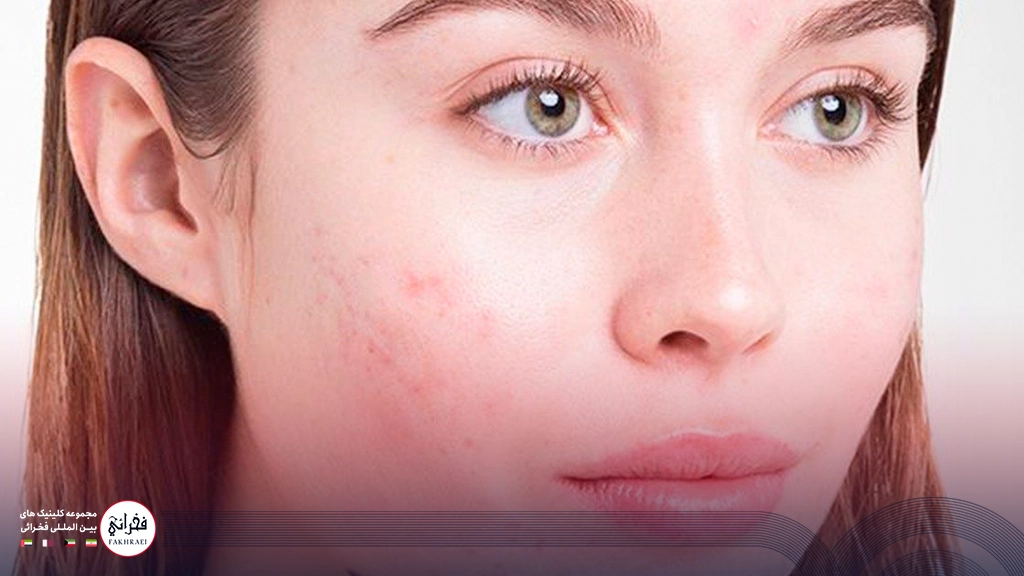 جوش‌های زیر پوستی صورت خانمی