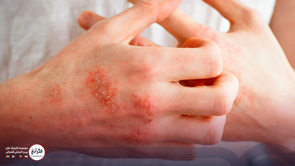 درمان اگزمای و خارش پوست دست