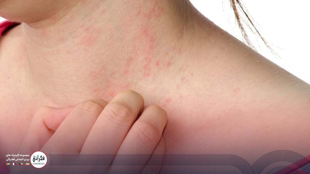 خارش پوست بدن در اثر اگزما