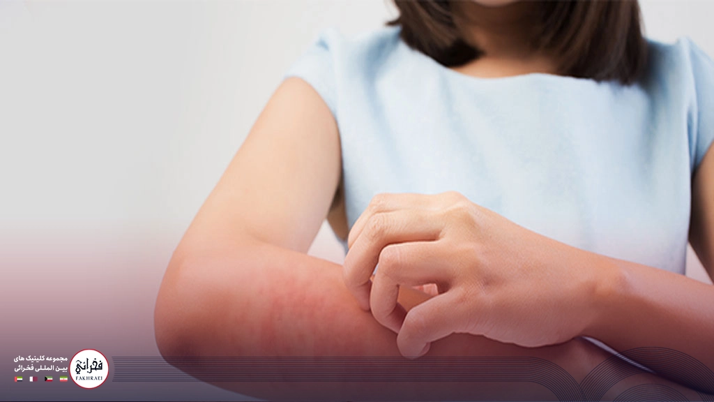 دختری در حال خاراندن دستش به دلیل اگزما