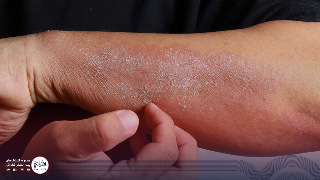  اگزمای پوست دست