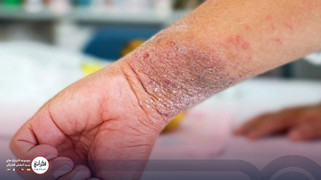 تشدید اگزمای پوست دست