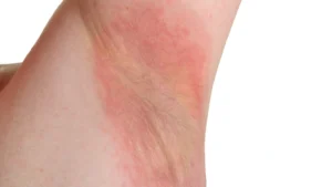 اینترتریگو