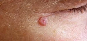 پوست سنگفرشی