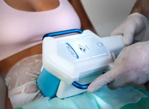 کرایولیپولیز