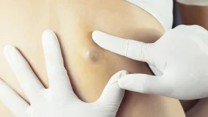 کیست کراتین