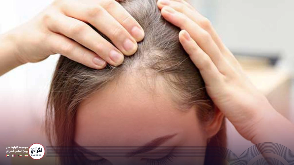 انواع ریزش مو در زنان و درمان آن