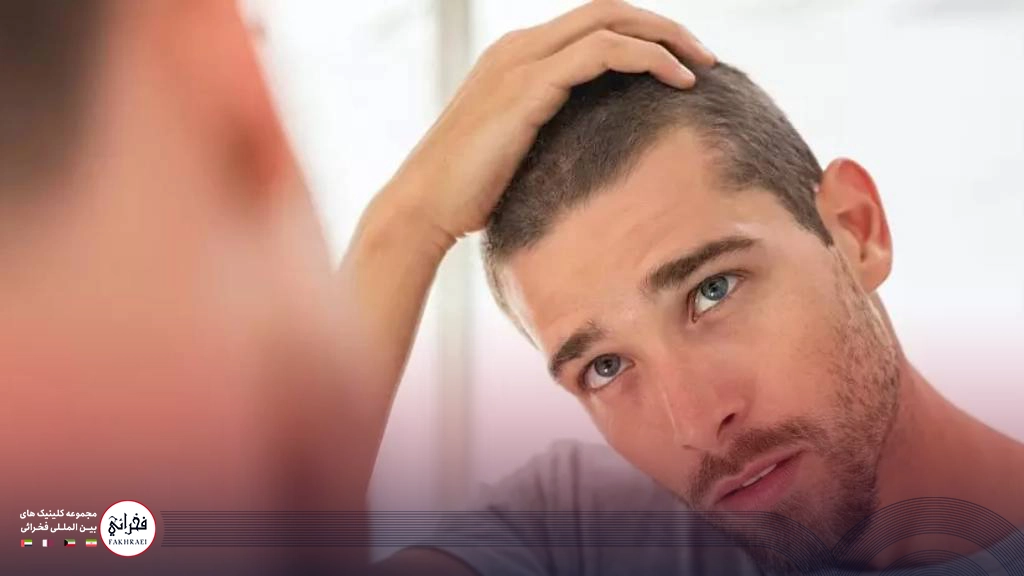 درمان ریزش مو در مردان