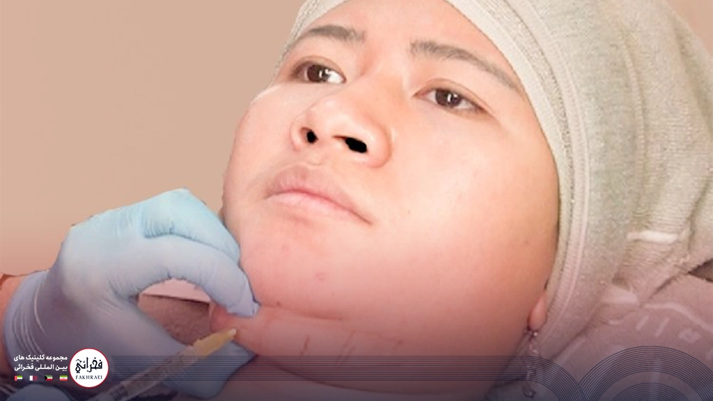 مزوتراپی غبغب