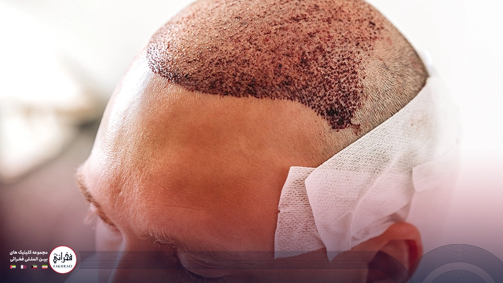 تاثیر محل کاشت مو بر قیمت