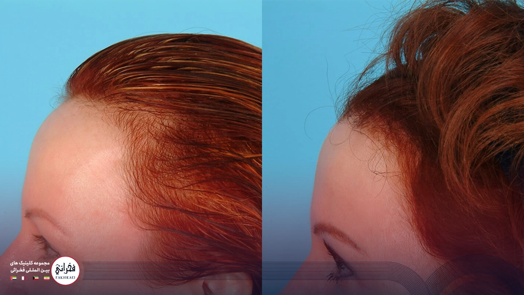 هزینه کاشت موی زنان