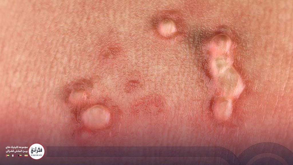 عکس زگیل تناسلی منتقل شده روی پوست