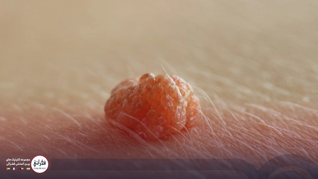 زگیل تناسلی منتقل شده از نمای نزدیک روی پوست یک بیمار