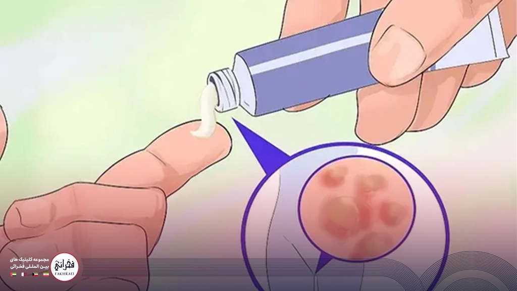 پماد برای درمان زگیل تناسلی