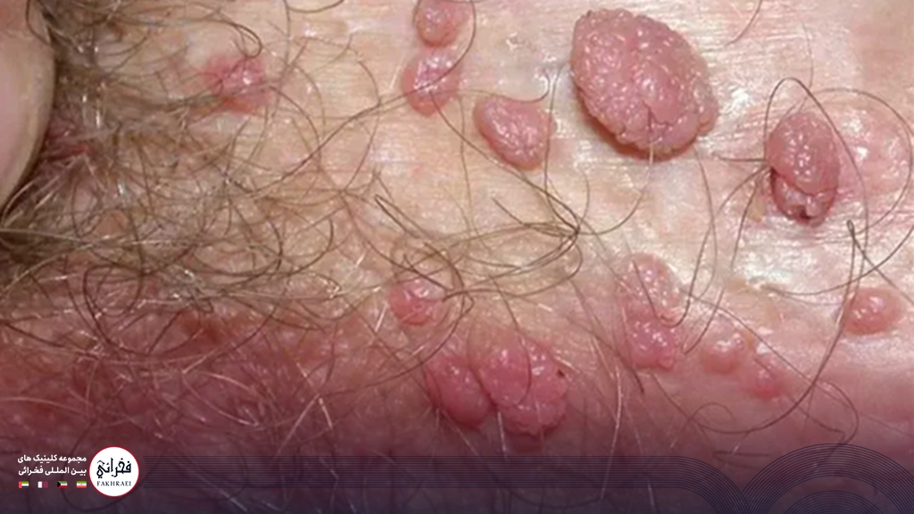 درمان قطعی زگیل تناسلی