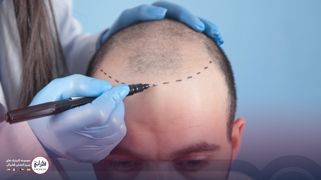متخصص درحال بررسی تعداد موهای لازم برای تخمین هزینه کاشت مو برای فردی با بانک موی ضعیف