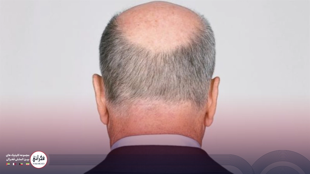 یک مرد که بانک موی قوی ندارد