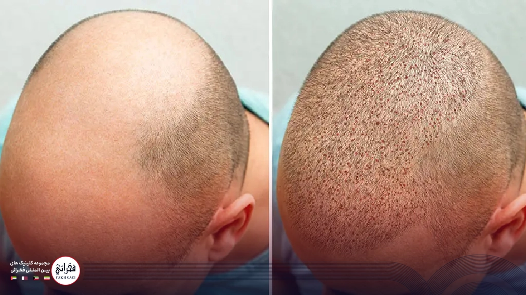 نتایج کاشت مو با بانک موی ضعیف