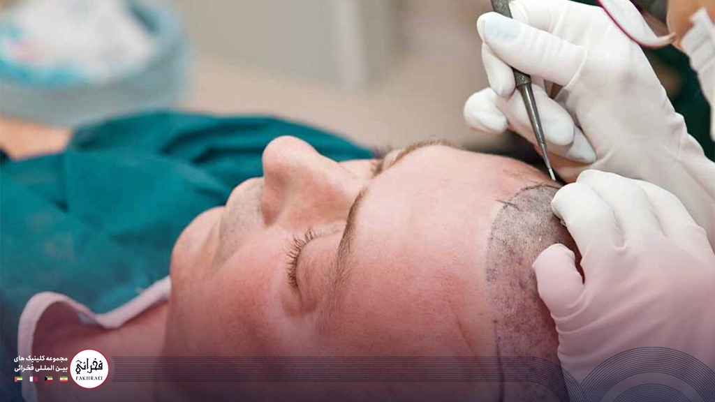 کاشت مو به روش میکروگرافت