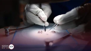 کاشت مو به روش میکروگرافت