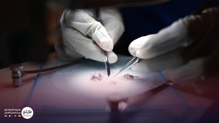 کاشت مو به روش میکروگرافت