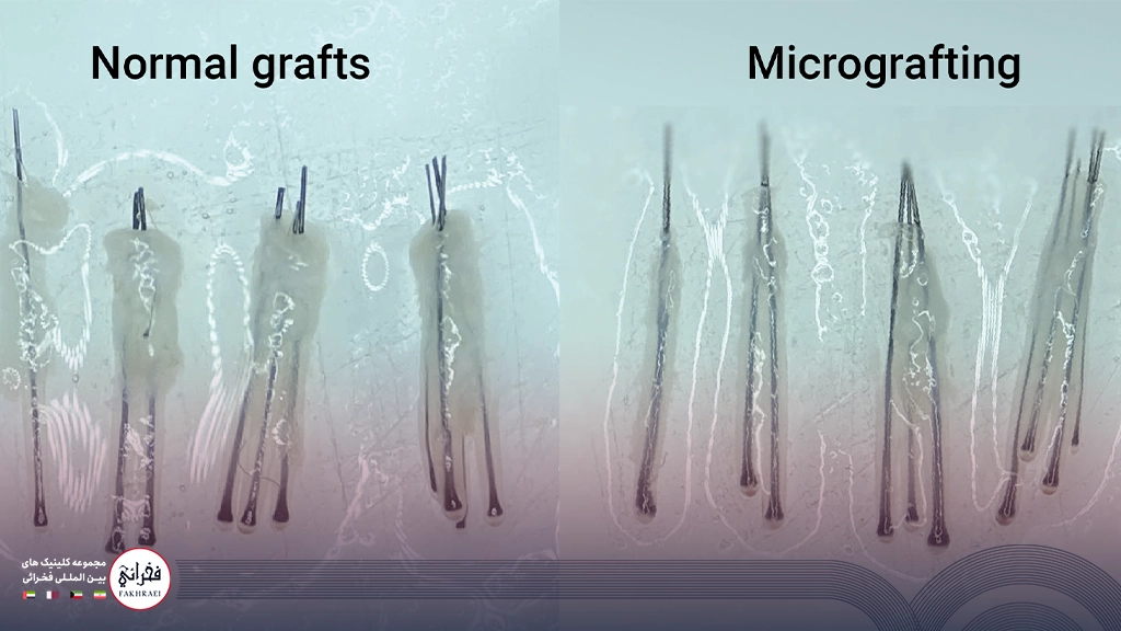 کاشت مو به روش میکروگرافت