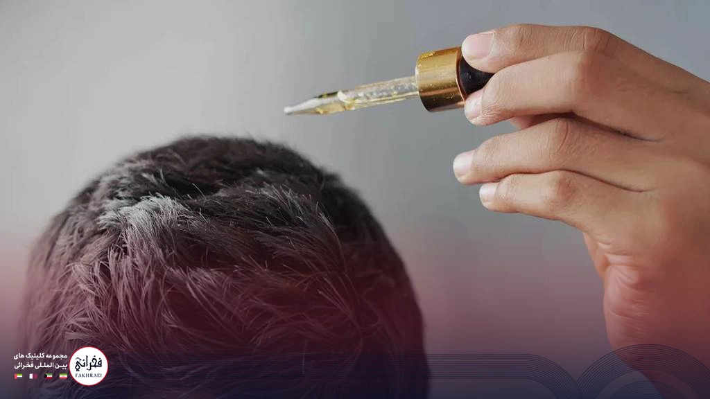 مردی درحال ریختن قطره ماینوکسیدیل بعد از کاشت مو