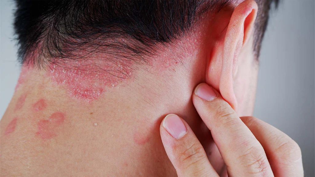 پسوریازیس (Psoriasis)