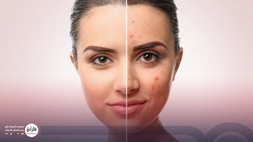 درمان جای جوش