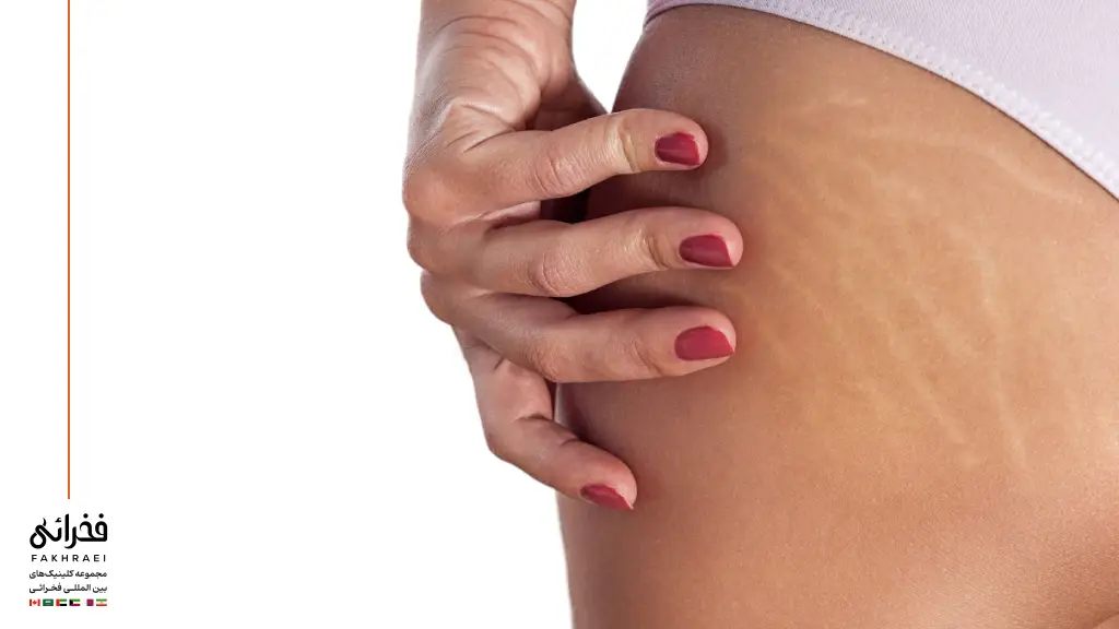 ترک پوستی روی ران