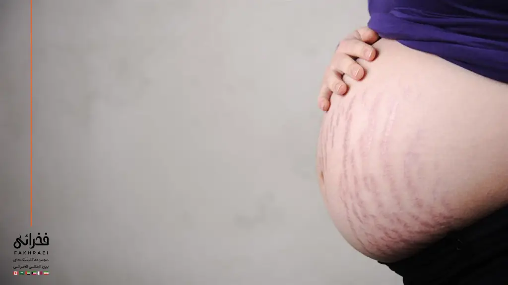 ترک پوستی بعد از بارداری