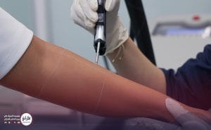 لیزر بانوان