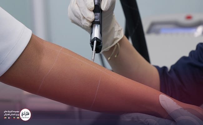 لیزر بانوان