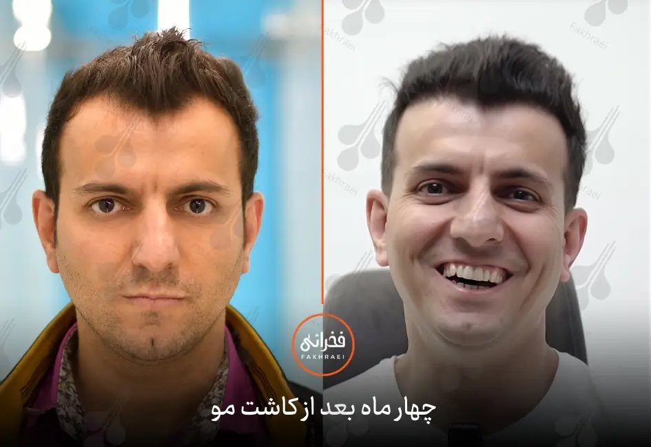 نتیجه کاشت مو بعد از چهار ماه