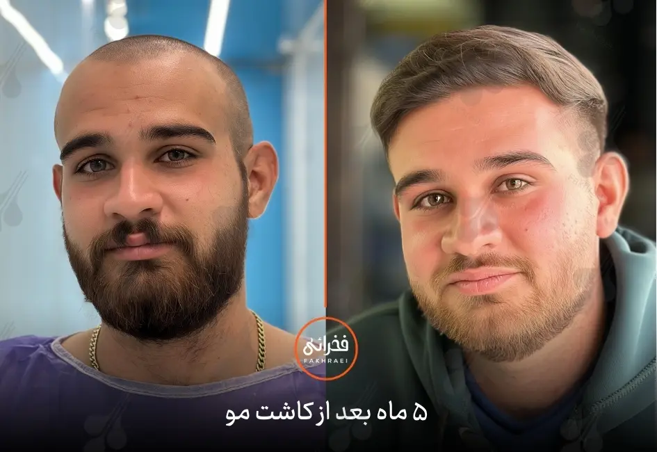 نتیجه کاشت مو بعد از پنج ماه