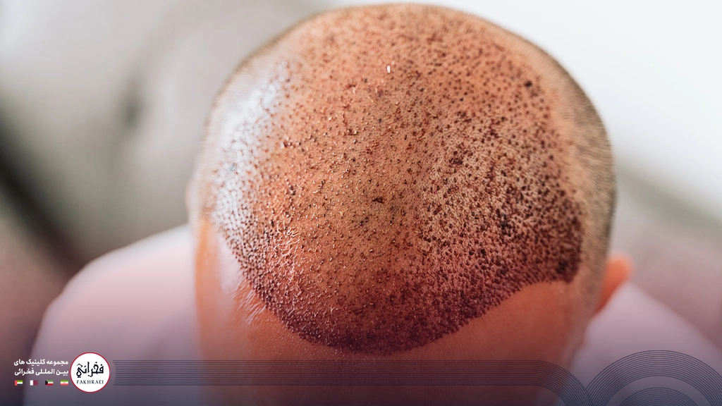 تصویر سر یک مرد پس از اتمام کاشت مو پرتراکم