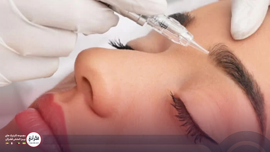 کاشت ابرو روشی دائمی برای تقویت ابروها