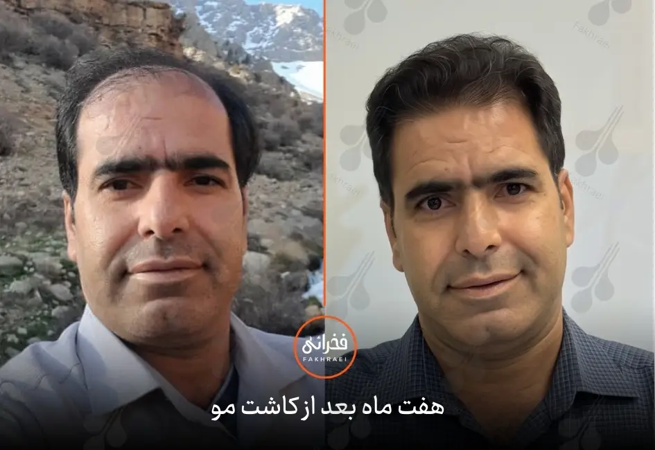 نتیجه کاشت مو بعد از هفت ماه