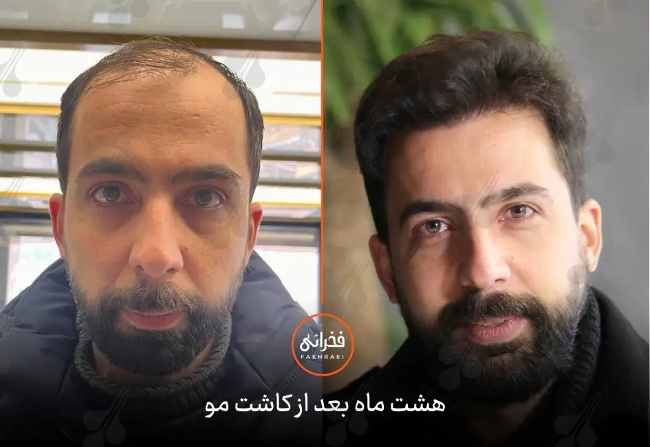 نتیجه کاشت مو بعد از نه ماه