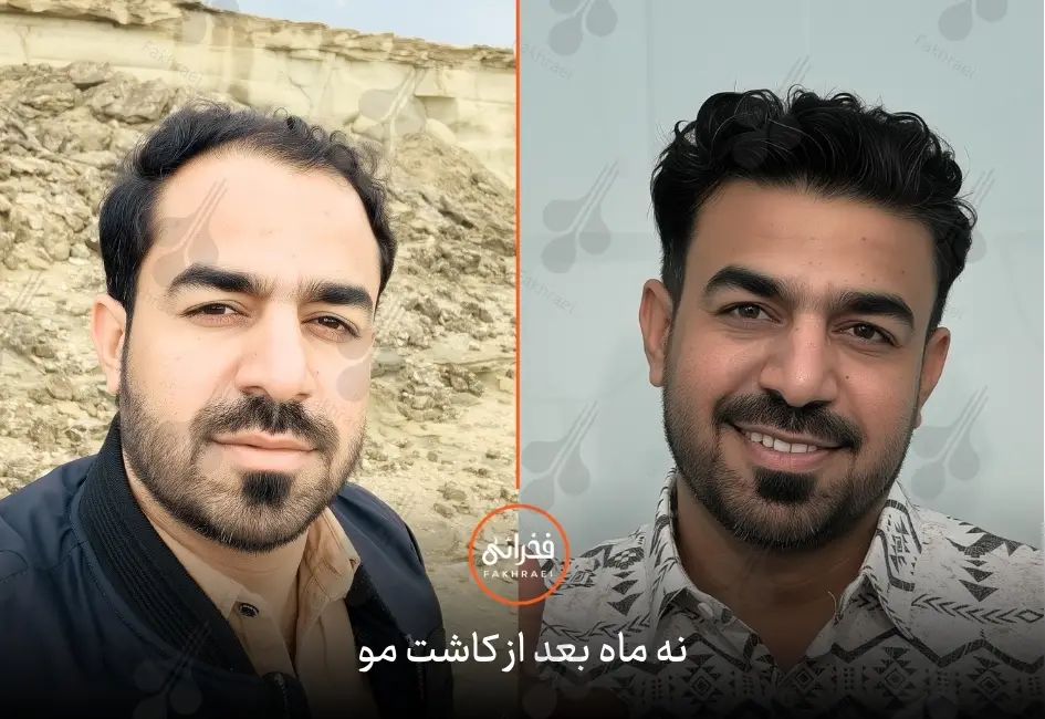 نتیجه کاشت مو بعد از نه ماه