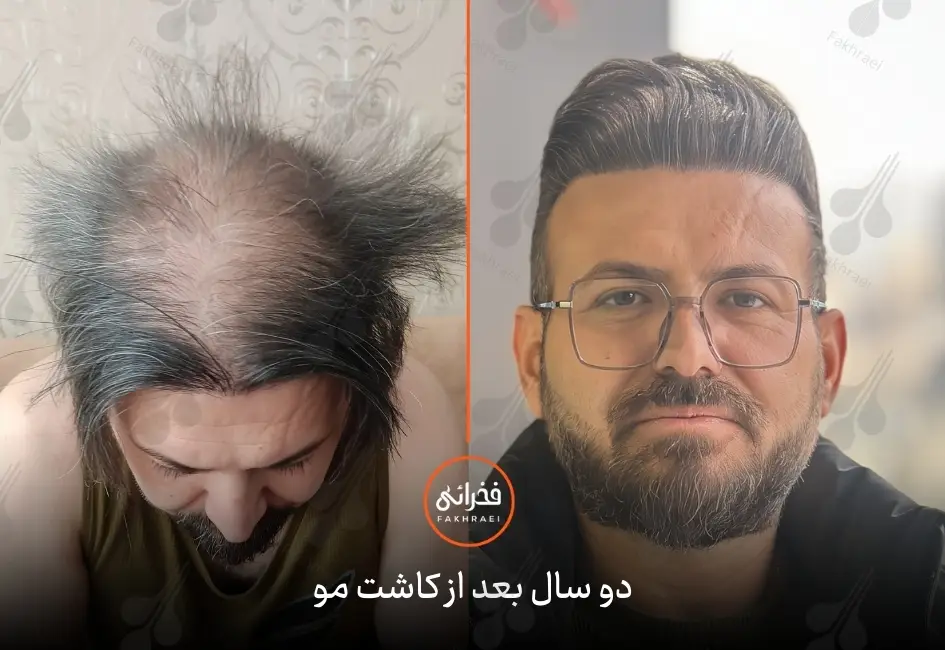 ۲ سال بعد از کاشت مو