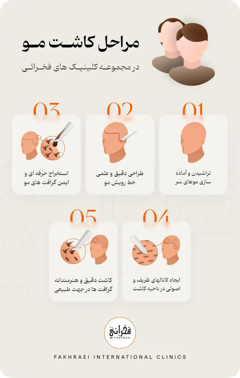5 مرحله اصلی کاشت مو