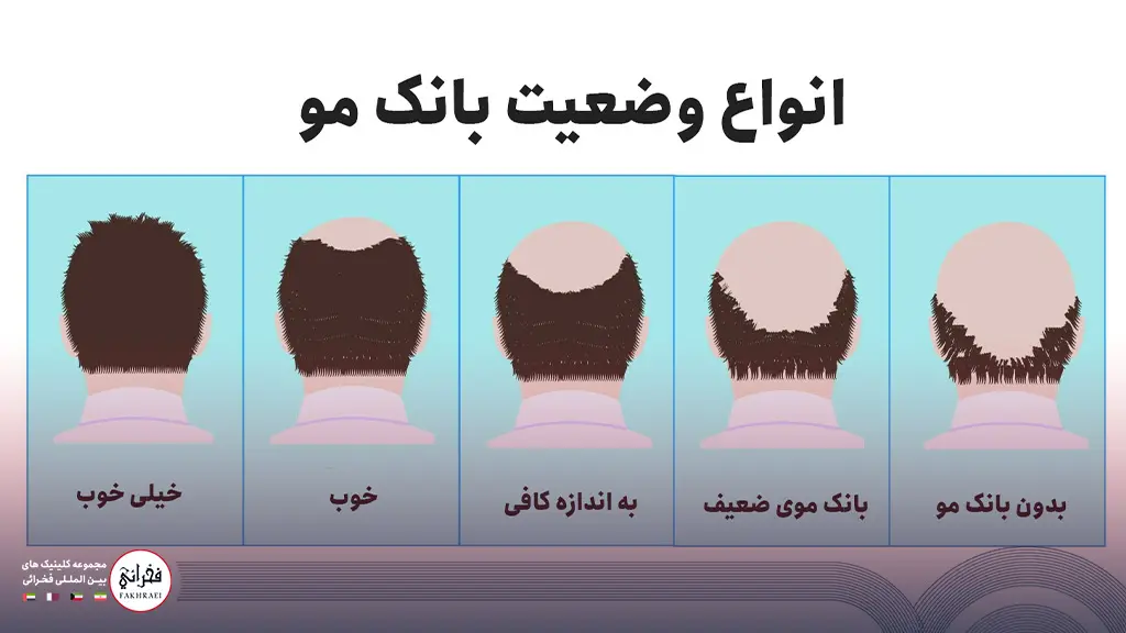 انواع وضعیت بانک مو از بهترین حالت تا افراد بدون بانک مو