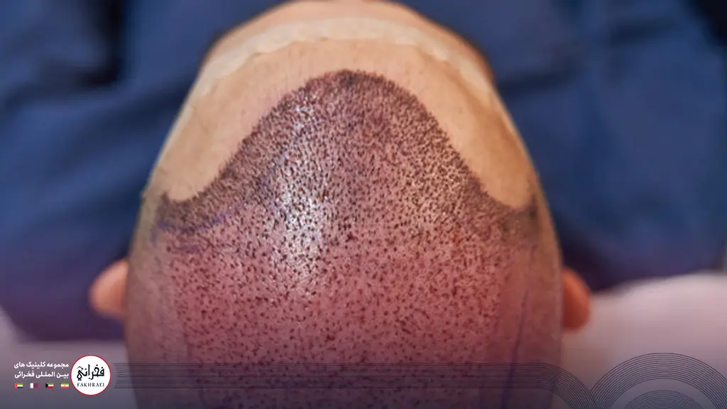 دلمه کاشت مو چیست؟