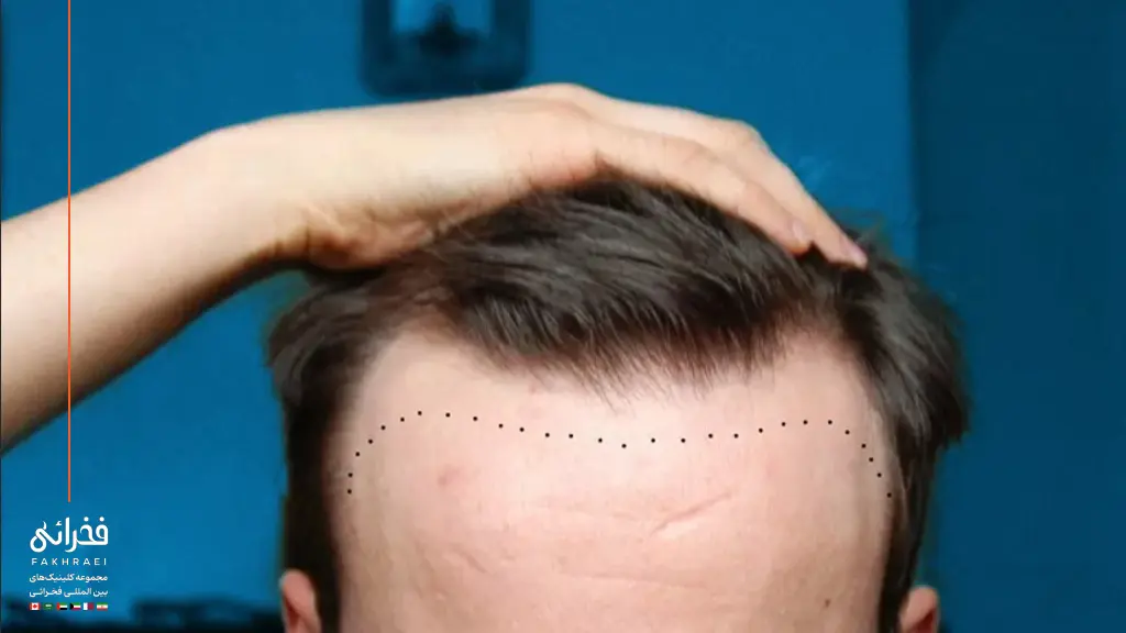 ناحیه کاشت مو در شقیقه